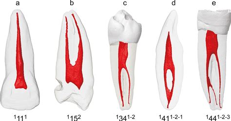 A new system for classifying root and root canal morphology - Ahmed ...