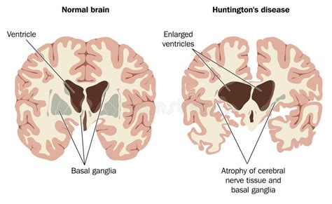 Brain Atrophy In Huntingtons Disease Stock Vector - Image: 58691985