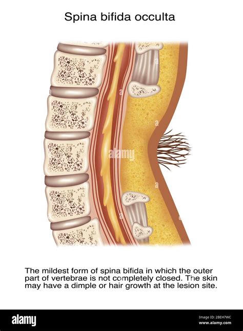 Spina Bifida Occulta Hair Patch