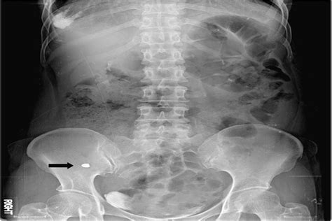 Perforated Appendicitis Caused by Foreign Body Ingestion : Surgical Laparoscopy Endoscopy ...