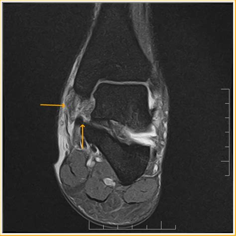 Deltoid Ligament Disruption : MRI - Sumer's Radiology Blog