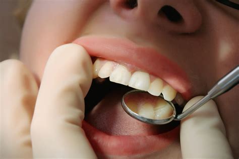 What is Dental Debridement? - Konig Center for Cosmetic & Comprehensive Dentistry