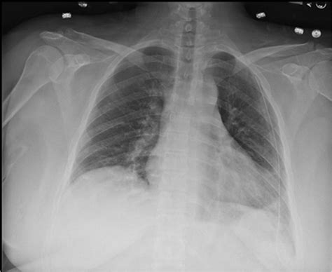 Chest X-ray taken on postoperative day 1 showing fully inflated lungs ...