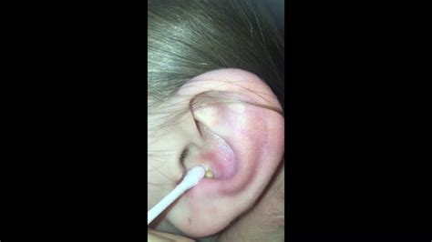 big pimple gets popped inside ear with a needle!!!! Chords - Chordify