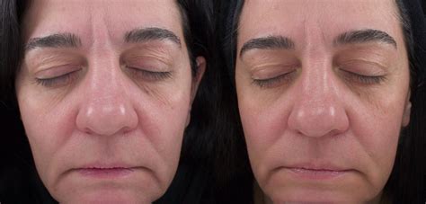 Microderm Md Before And After - Aquagold Before And After Gallery / Microdermabrasion isn't just ...