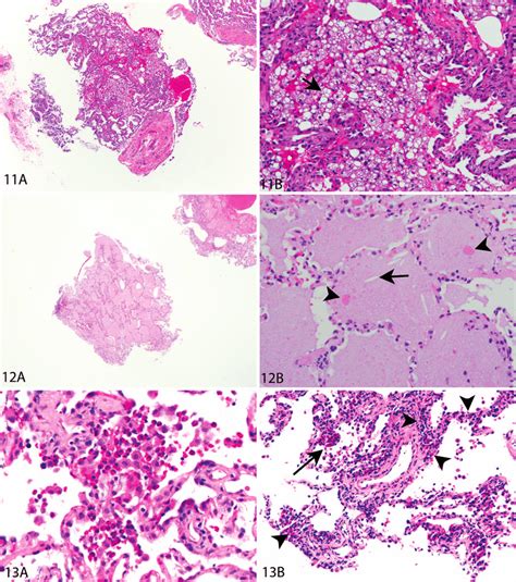 Exogenous lipoid pneumonia in a transbronchial lung biopsy. A, Low ...