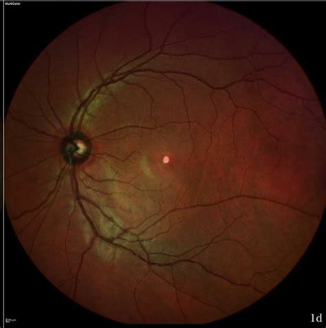 OCT SD and Multicolor of both eyes. Vitritis is seen in the right eye... | Download Scientific ...