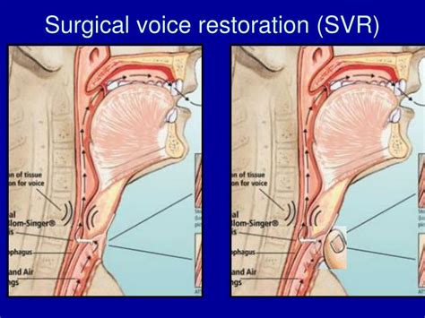 PPT - Laryngectomy – surgical and SLT perspectives PowerPoint ...