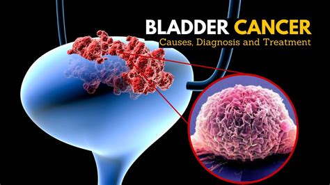 Bladder Cancer, Causes, Signs and Symptoms, Diagnosis and Treatment ...