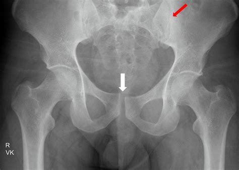 Atypical APC-1 pelvic fracture presenting with pelvic instability ...