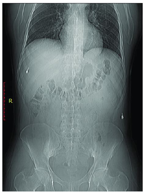 Bilateral sacroiliitis. X-ray for a 41-year-old male presenting with Rt... | Download Scientific ...