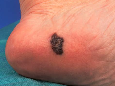 SBS Language | New melanoma treatment halves chances of the disease reappearing