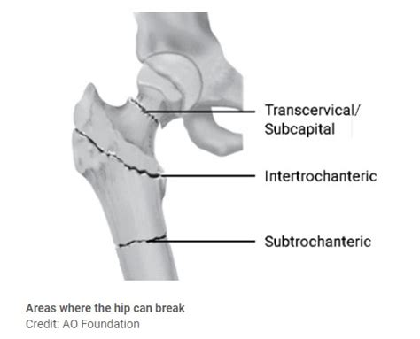 Surgery to Repair a Hip Fracture: Learning about