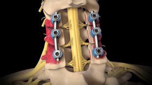 Cervical Laminectomy surgery in India, hospitals, doctors