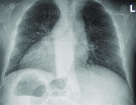 Preoperative chest radiograph showing dextrocardia and chronic... | Download Scientific Diagram