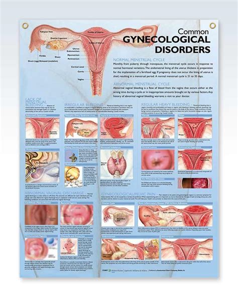 Gynecological Disorder Exam-Room Anatomy Posters – ClinicalPosters