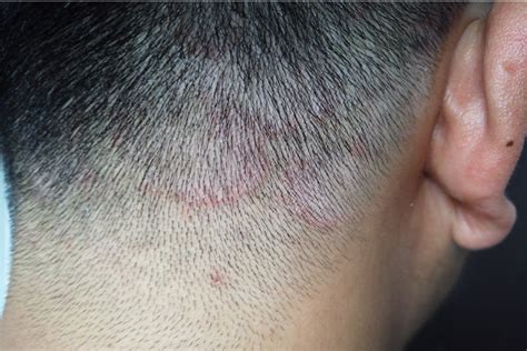 Ringworm On Scalp - Symptoms, Causes & Treatment – Traya