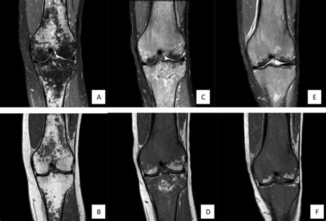 MRI of the left knee showing multiple focal bone marrow lesions which... | Download Scientific ...