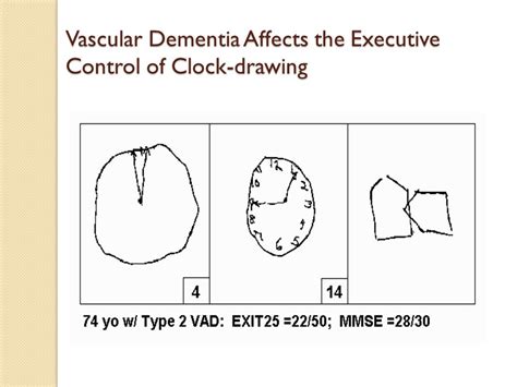 Dementia Clock Drawing at GetDrawings | Free download