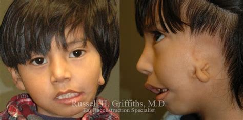 Goldenhar Syndrome - Hemifacial Microsomia - Dr. Griffiths