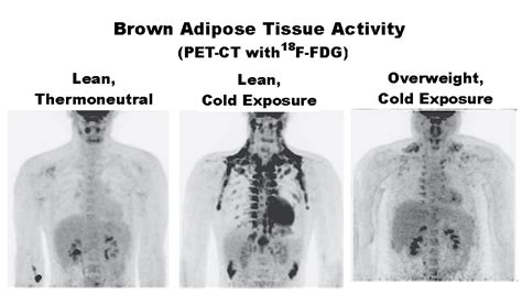 Brown fat could play key role in fighting obesity