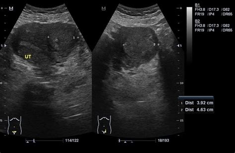 Uterine Fibroids Ultrasound