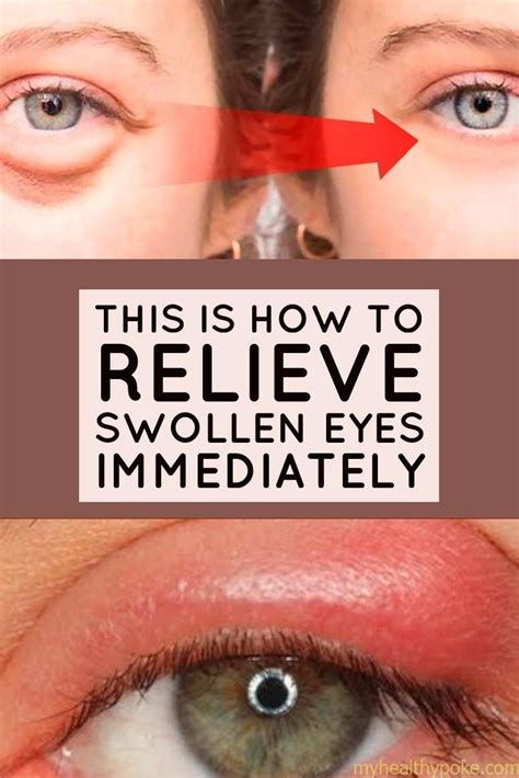 Use 10 tricks to fight swollen eyes - My Healthy poke | Swollen eyes, Swollen eye remedies ...