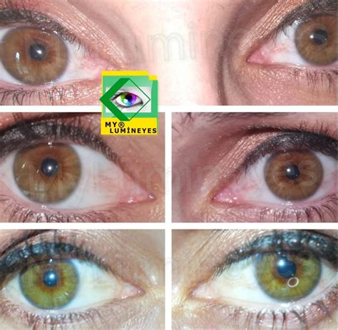 Laser Permanent Eye Color Change Without Surgery Procedure (Mylumineyes) | by Mylumineyes | Medium