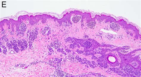 Compound Nevus Histology