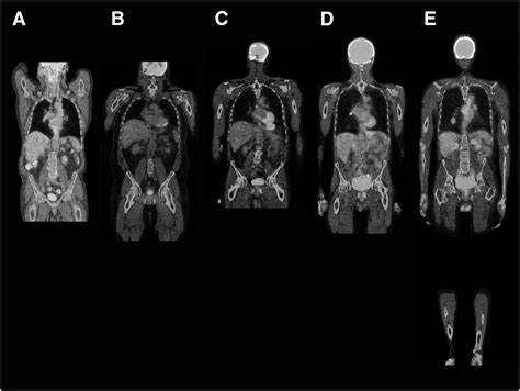 Whole-Body 18F-FDG PET/CT: The Need for a Standardized Field of View—A Referring-Physician Aid ...