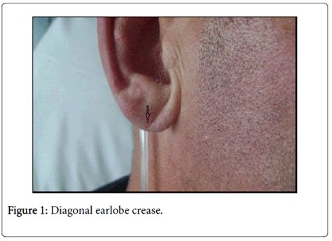 The Forgotten Clinical Sign: The Use of Diagonal Earlobe Crease in the Detection of Coronary ...