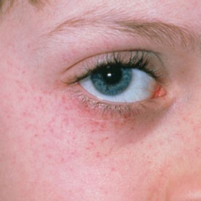 Red Dots Around Eyes: Causes, Treatment, and When to Worry