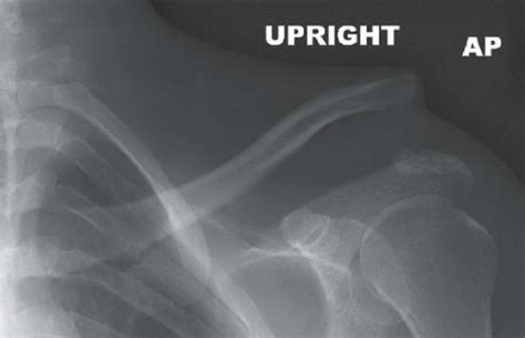 ZMC Fracture | Radiology Key