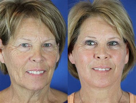 Before and After Facelift Photos | Youthful Reflections | Co2 laser ...