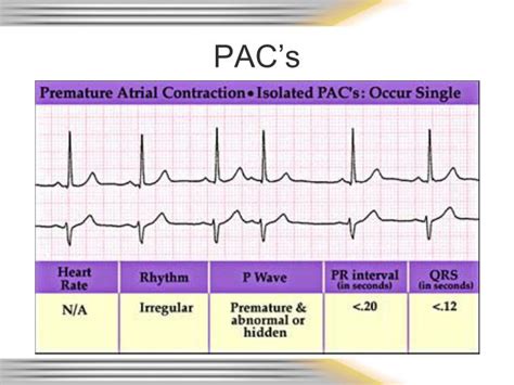 PPT - Rhythm & 12 Lead EKG Review PowerPoint Presentation - ID:359042