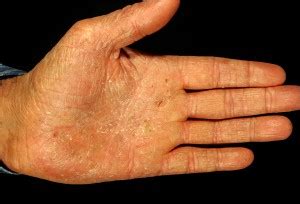 Pompholyx (Dyshidrosis) – Pictures, Symptoms, Causes and Treatment