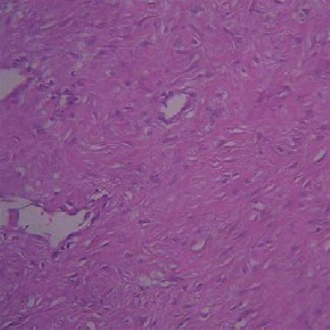 Myofibroblast proliferation with dense collagenous background.... | Download Scientific Diagram