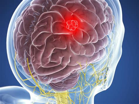 Meningioma - Symptoms, Causes & Risk Factors