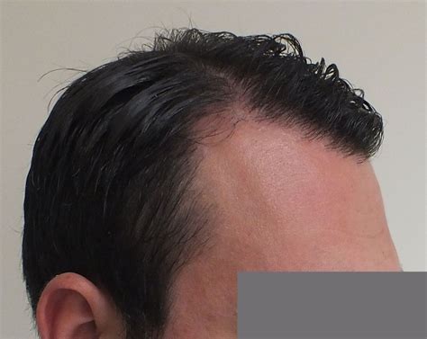 Pin on Dr. Ekrem Civas Hair Transplant Turkey. Case 2. 3200 grafts FUE 7months after