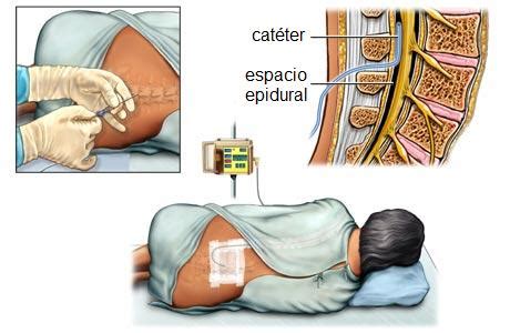 La Anestesia Epidural, que es y cual es el procedimiento