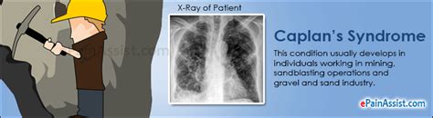 Caplan syndrome,what to know?