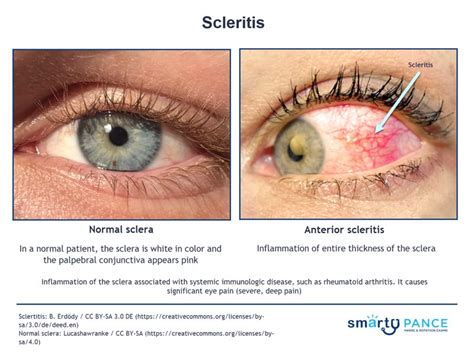 Scleritis | EENT PANCE Content Blueprint - Smarty PANCE