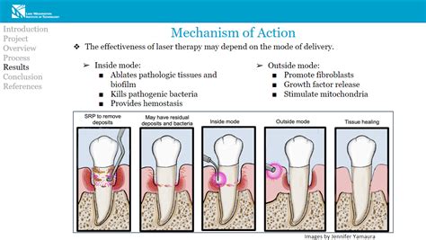 Laser Therapy as an Adjunct to SRP for the Treatment of Chronic Periodontitis Compared to SRP ...