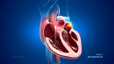 Cardiac Ablation Video | Medical Video Library