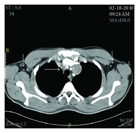 Mediastinal Lymph Nodes Ct Scan