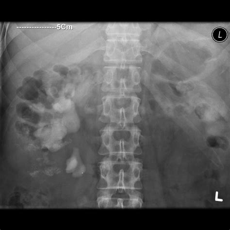 Pyelonephritis x ray - wikidoc