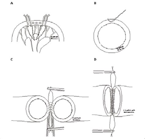 4: Segmental resection of ileum with perforations and end-to-end ...