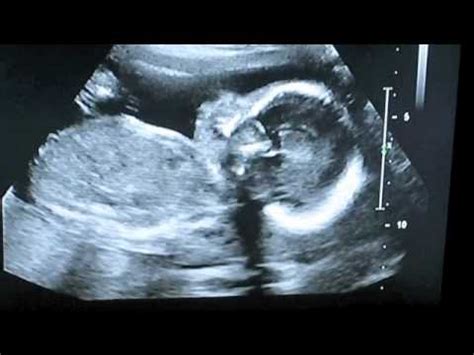 22 week ultrasound - YouTube