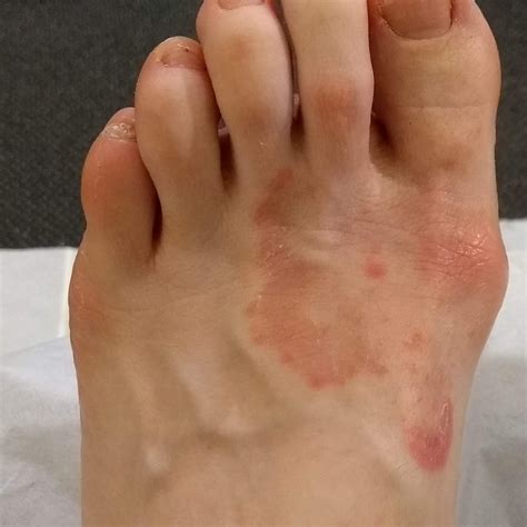 Fungal Foot Problems - Footman Podiatry and Gait Analysis Clinics