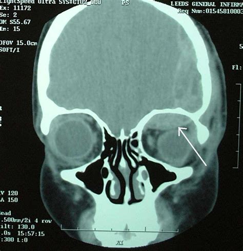 Traumatic Subperiosteal Hematoma of the Orbit: A Report of 2 Cases ...